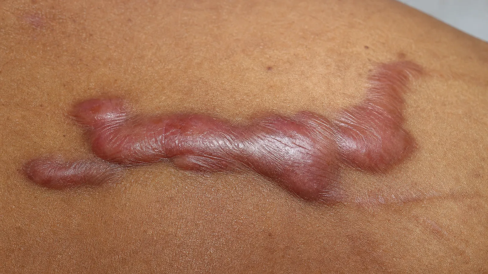 Keloid Nedir, Neden Oluşur? Hipertrofik İzden Farkı