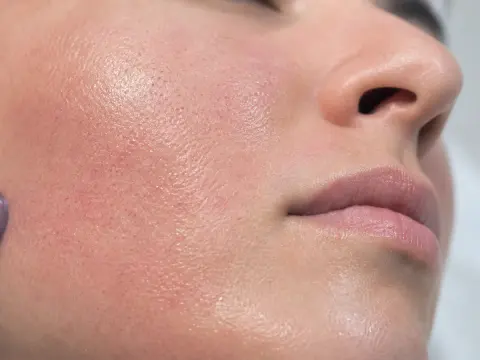 Dermapen (Mikroiğneleme): Nasıl Çalışır, Kimler İçin